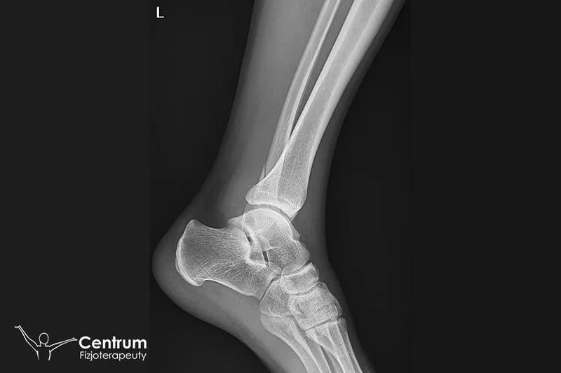 Ćwiczenia domowe po złamaniu kostki