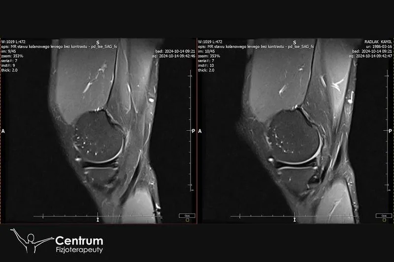 Czas rekonwalescencji po operacji łąkotki