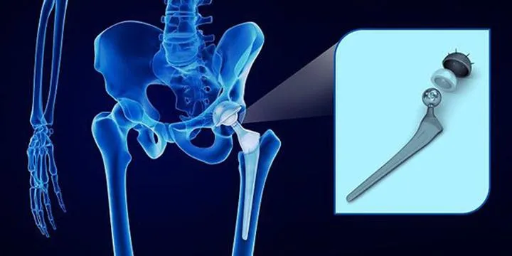 Etapy rehabilitacji po endoprotezie