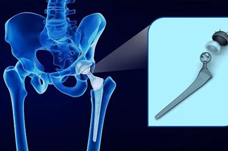 Etapy rehabilitacji stawu biodrowego