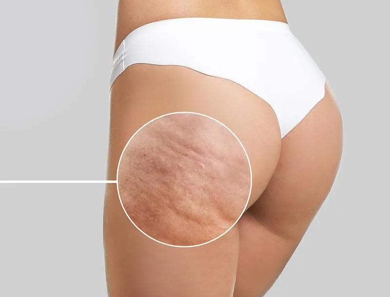 Naturalne olejki na cellulit