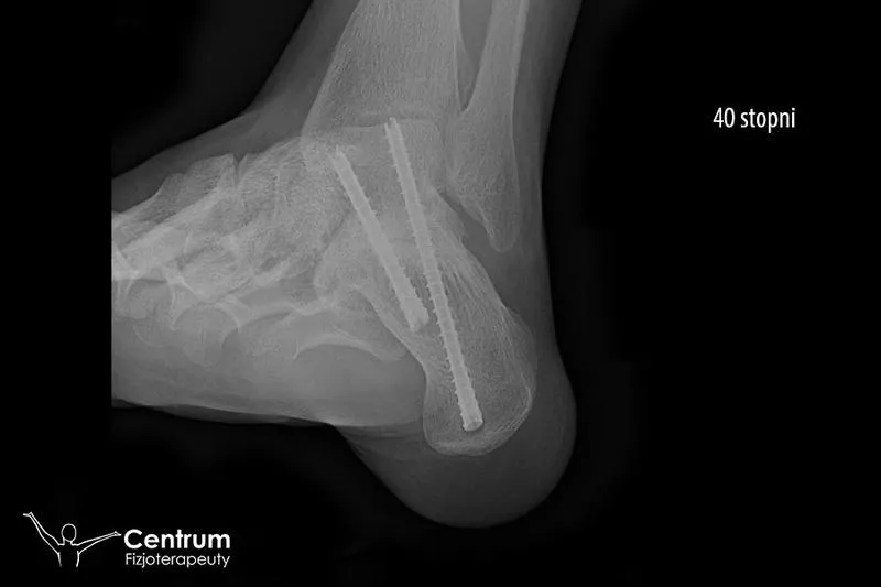 Powrót do pełnej sprawności po kontuzji