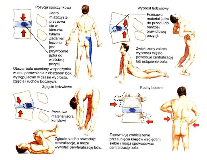 Rehabilitacja metodą McKenziego