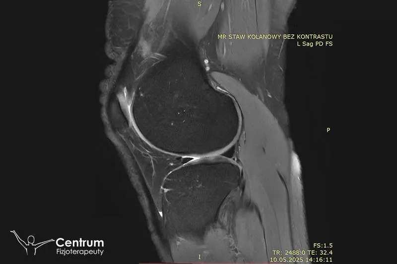 Rehabilitacja po artroskopii łąkotki