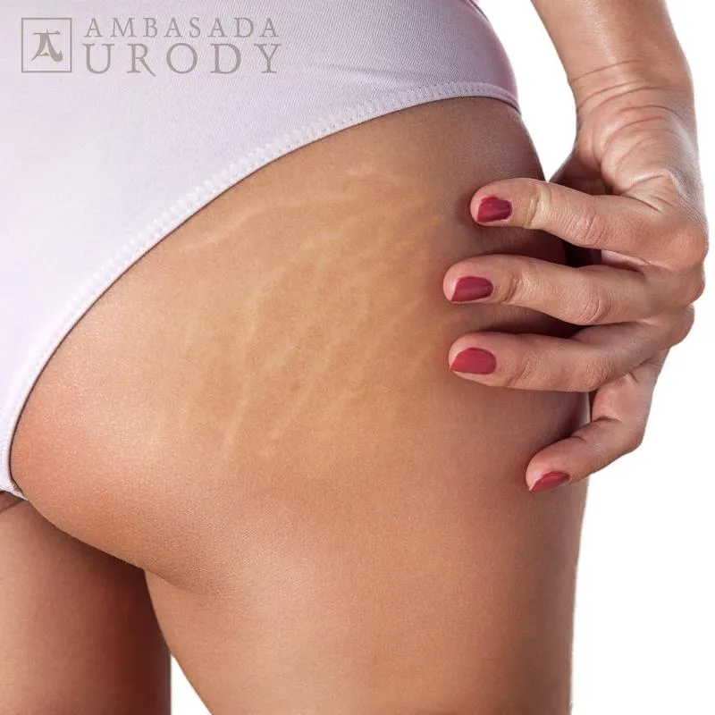 Techniki masażu antycellulitowego